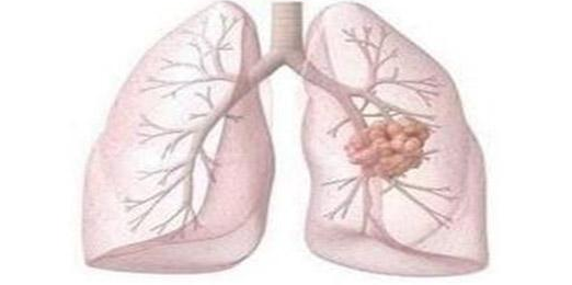奥希替尼能部分延长肺癌患者的生命