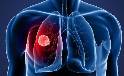 这五种饮食能预防肺癌