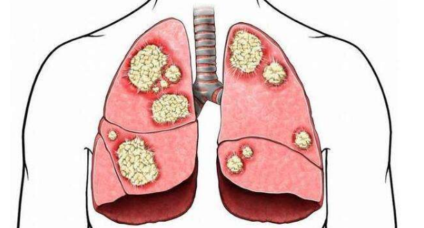 肺癌在早期诊断治疗很重要