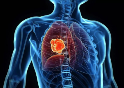 肺癌晚期延长生命的方法