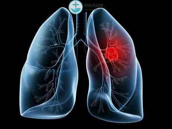 有哪些早期症状是肺癌表现？